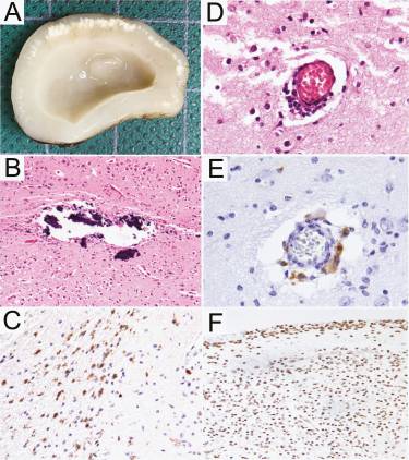 Congenital Zika Syndrome and Extra-Central Nervous System Detection of Zika Virus in a Pre-term Newborn in Mexico