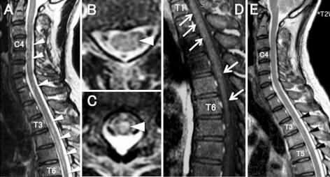 Longitudinally Extensive Transverse Myelitis and Optic Neuropathy Associated with Syphilitic Meningomyelitis and Human Immunodeficiency Virus Infection: A Case Report and Review of the Literature