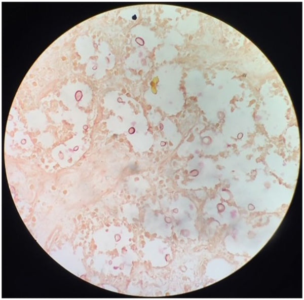 Cryptococcal Meningitis Presenting as New-Onset Seizures in an Immunocompetent Patient