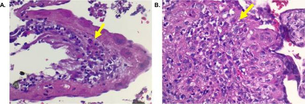 Efficient transplacental IgG transfer in women infected with Zika virus during pregnancy