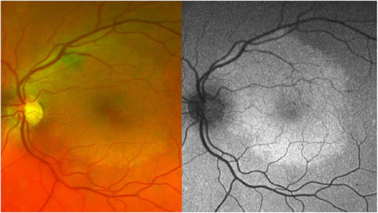 Ocular syphilis: the re-establishment of an old disease