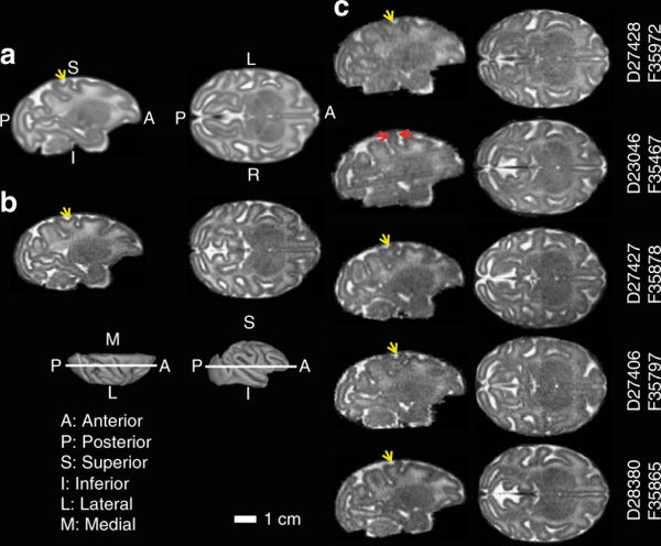 Zika virus infection in pregnant rhesus macaques causes placental dysfunction and immunopathology