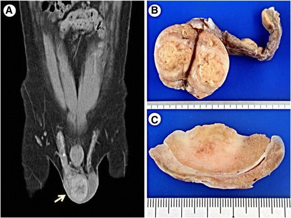 Syphilitic orchitis mimicking a testicular tumor in a clinically occult HIV-infected young man: a case report with emphasis on a challenging pathological diagnosis